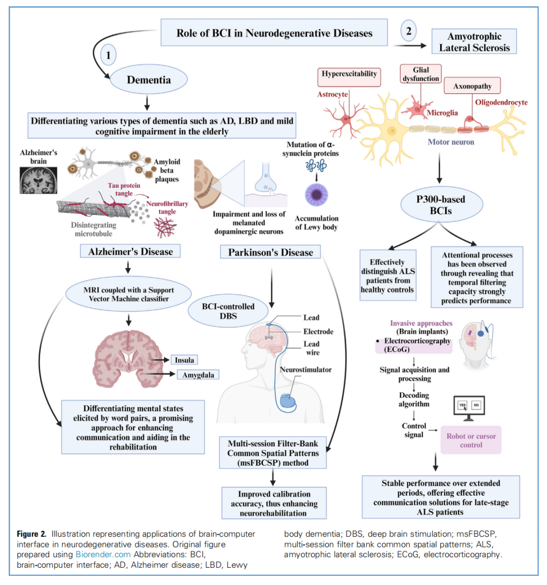 BCI 技术在神经退行性疾病中的应用.png